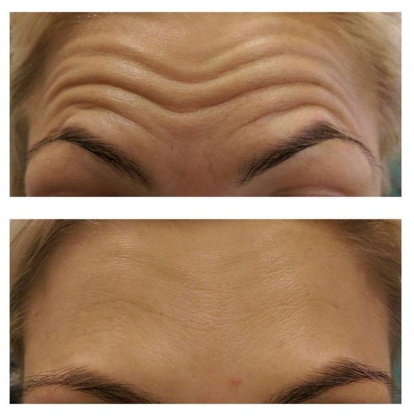 Wrinkles before and after Martock Dental